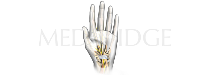 Best Tests for Carpal Tunnel Syndrome