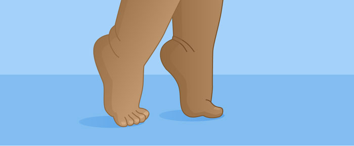 Why Toe Walking Is NOT Idiopathic