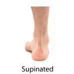 supinated foot