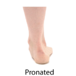 Pronated foot