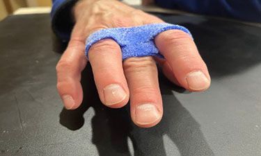 Hand with three-finger orthosis