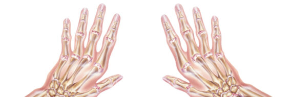 Illustration of two hands with zig-zag deformity