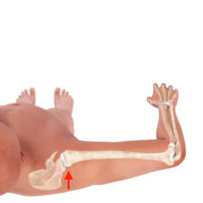 An illustration of the shoulder in the second 50 percent position.
