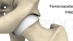Diagram of pincer-type femoroacetabular impingement with extra bone growth on the acetabulum causing hip movement limitation, as shown in medbridge.