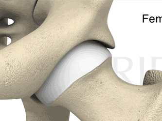 Diagram of pincer-type femoroacetabular impingement with extra bone growth on the acetabulum causing hip movement limitation, as shown in medbridge.