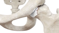 A close-up of a hip joint model with a beige pelvis, femur, and a white artificial joint is displayed.