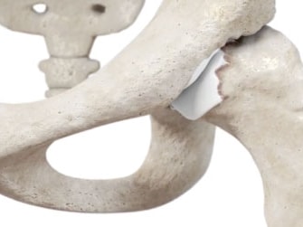 A close-up of a hip joint model with a beige pelvis, femur, and a white artificial joint is displayed.