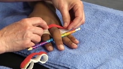 A hand therapist fabricates a relative motion yoke orthosis for extensor tendon repair using thermoplastic material and a colorful pencil for positioning.
