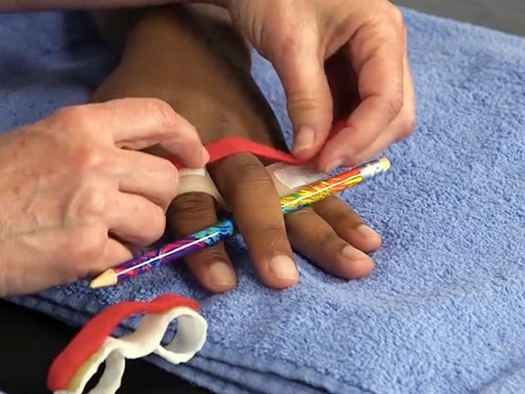 A hand therapist fabricates a relative motion yoke orthosis for extensor tendon repair using thermoplastic material and a colorful pencil for positioning.