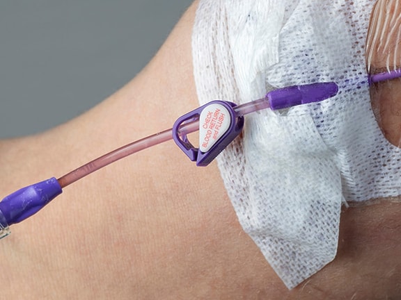 Close-up of an arm with a catheter and connectors, secured with white tape, for medbridge use.