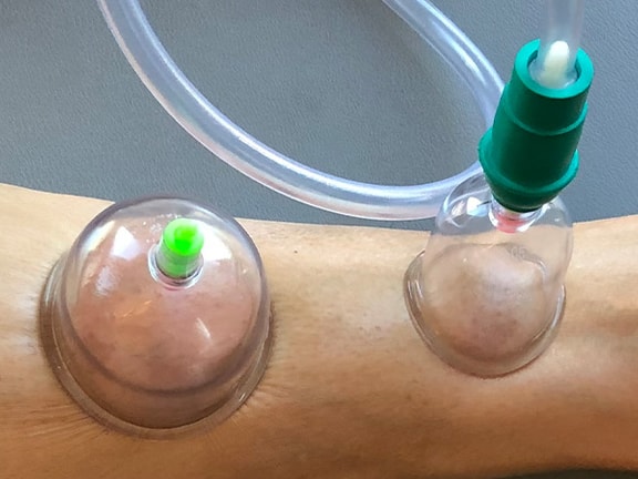 How Cupping Therapy Enhances Mobility and Reduces Pain