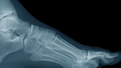 Ottawa Ankle Rules