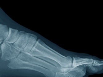Ottawa Ankle Rules