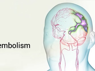 Diagram of a human head with a cerebral embolism causing an ischemic stroke from medbridge.