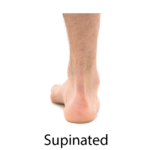 A person's bare foot and ankle viewed from behind, symbolizing the blend of physical health and digital insights with medbridge.