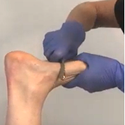 Medbridge user in blue gloves fits device on an ankle.
