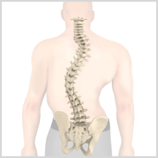 Illustration of a human back showing spinal curvature, indicating scoliosis, for medbridge healthcare education.