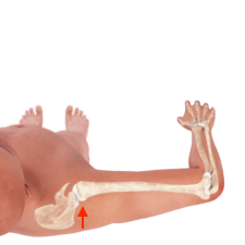 Illustration highlighting arm bone structure with an arrow, ideal for Medbridge healthcare education.