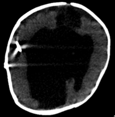 CT image of a brain showing a dark area suggesting hemorrhage or injury.
