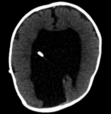 CT scan displaying a darkened area and a bright foreign object in the brain.