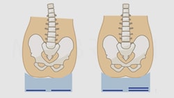 Comparison of posterior pelvic tilt and neutral pelvis with spinal alignment illustrations.