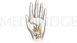 Medbridge medical illustration of hand anatomy, showing nerves, tendons, and bones.