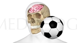 Illustration of a skull showing brain, hit by a soccer ball.