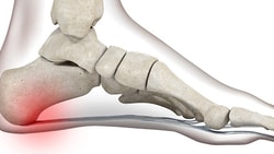 An illustration highlighting heel pain in a foot's skeletal structure, by medbridge.