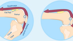 Diagram of knee anatomy highlighting the quadriceps, fat pad, femur, patellar tendon, fibula, and tibia from two angles.
