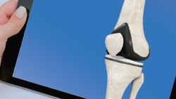 Someone holds a tablet showing a knee joint model in Medbridge on blue.