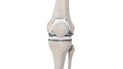 Illustration of a human knee with a prosthetic implant, displaying the femur, tibia, and kneecap.
