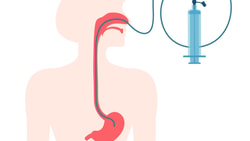 Nasogastric tube inserted through nose into stomach, attached to syringe for medical use, as shown in medbridge materials.