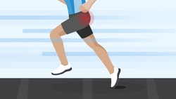 Medbridge illustration of a runner on a treadmill with emphasis on the knee.