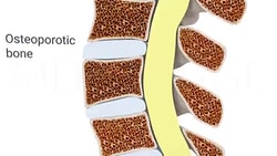 Diagram showing a spine cross-section with osteoporotic and normal vertebrae in pale colors for medbridge.