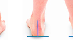 Three rear views of feet with blue lines showing pronation, neutral, and supination ankle alignments.