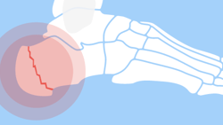 Illustration of a heel fracture with the crack highlighted in red.