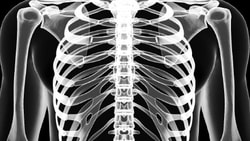 X-ray of a chest showing ribs, spine, and shoulders on a black background.