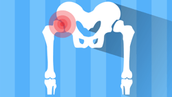 Silhouette of a pelvic bone on blue stripes with a red circle highlighting the hip joint for medbridge.