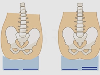 Comparison of posterior pelvic tilt and neutral pelvis with spinal alignment illustrations.