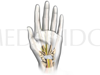 Medbridge medical illustration of hand anatomy, showing nerves, tendons, and bones.