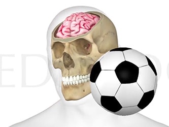 Illustration of a skull showing brain, hit by a soccer ball.