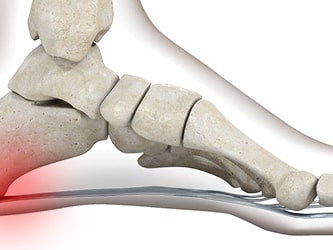 An illustration highlighting heel pain in a foot's skeletal structure, by medbridge.
