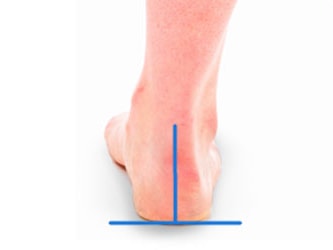 Three rear views of feet with blue lines showing pronation, neutral, and supination ankle alignments.