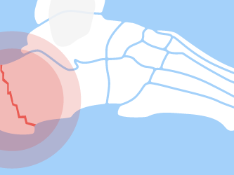 Illustration of a heel fracture with the crack highlighted in red.