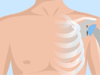 Illustration of a human upper body with ribs, heart, lungs, and a pacemaker near the left shoulder on a blue background.