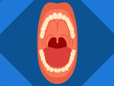 Illustration of an open mouth with teeth, tongue, and uvula against a blue background featuring arrow shapes for medbridge.