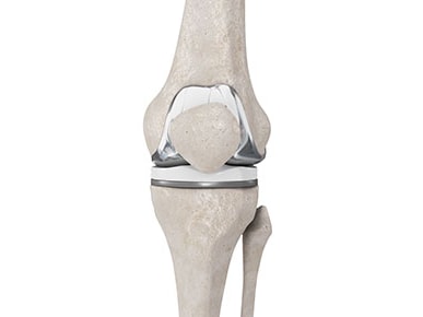 Illustration of a human knee with a prosthetic implant, displaying the femur, tibia, and kneecap.