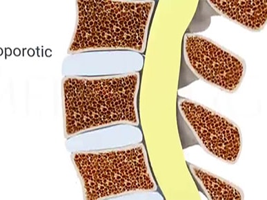 Diagram showing a spine cross-section with osteoporotic and normal vertebrae in pale colors for medbridge.
