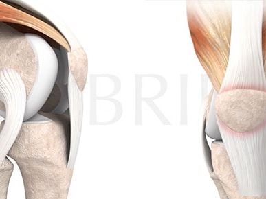 An anatomical illustration of a human knee joint showing side and front views with muscles, tendons, and bones highlighted for Medbridge.