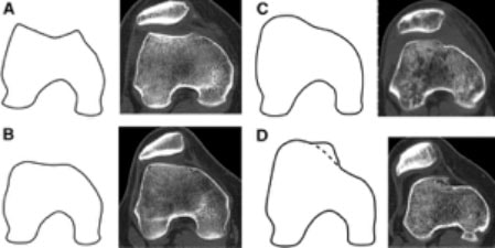 Medbridge image comparison of knee joints A-D to X-rays highlights bone structure and alignment differences for better care.